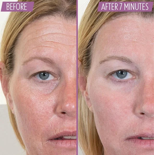 Athena 7 Minute Lift Before and After 1