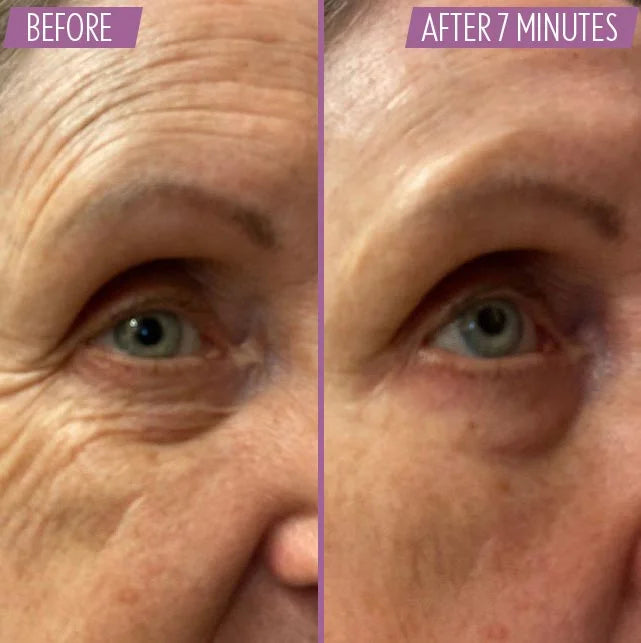 Athena 7 Minute Lift Before and After 4