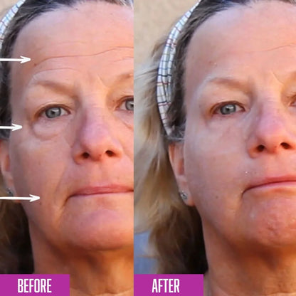 Before and after comparison of a woman's face with visible improvements.