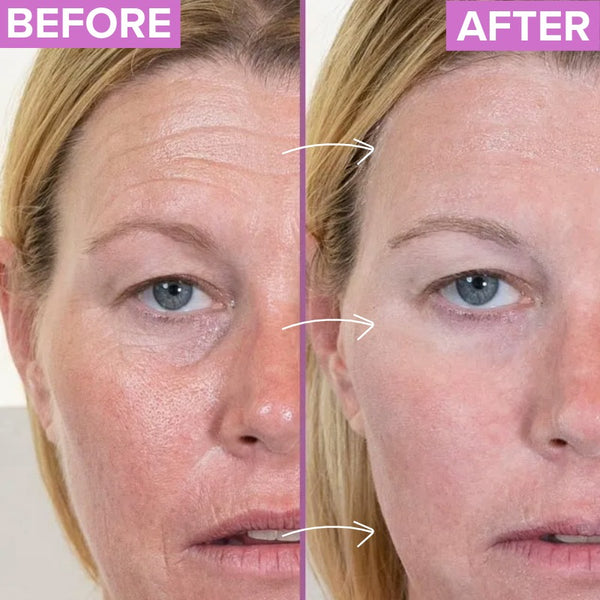 Clinical Study - Athena 7 Minute Lift