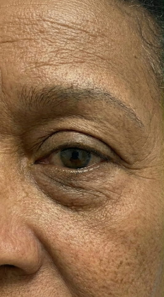 Athena 7 Minute Lift Before and After