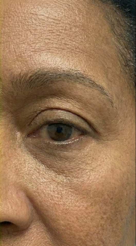 Athena 7 Minute Lift Before and After