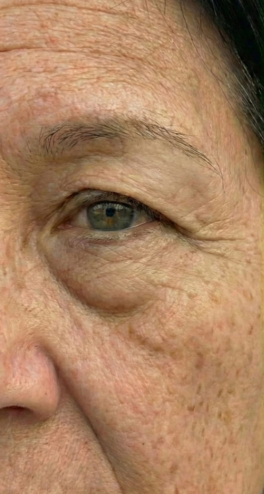 Athena 7 Minute Lift Before and After