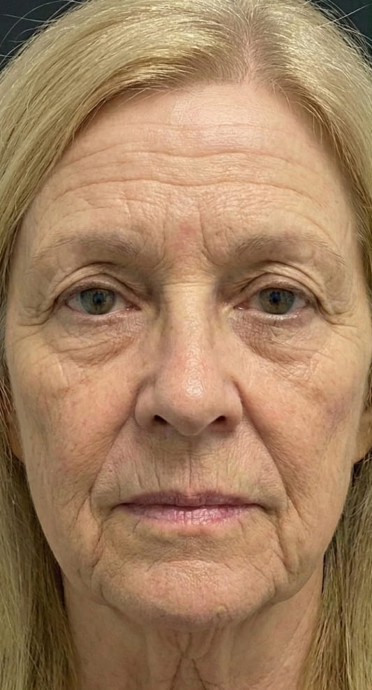 Athena 7 Minute Lift Before and After