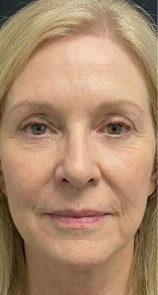 Athena 7 Minute Lift Before and After