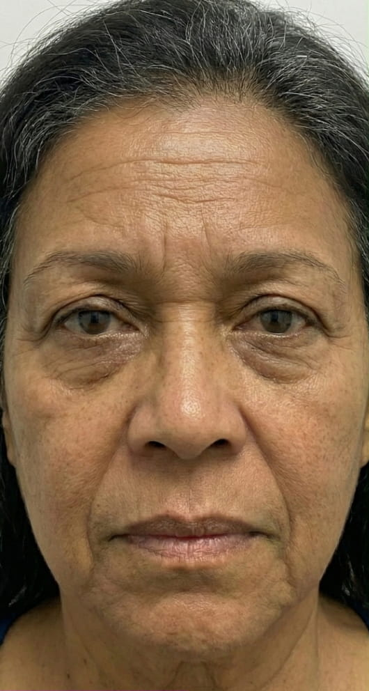 Athena 7 Minute Lift Before and After