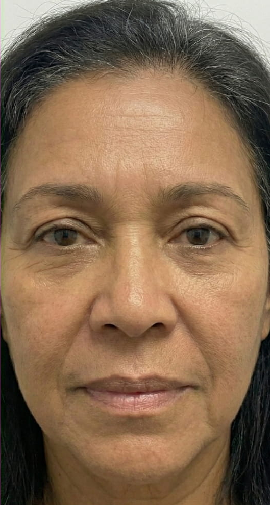 Athena 7 Minute Lift Before and After