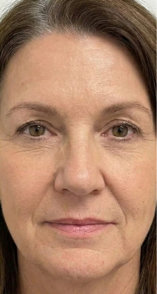 Athena 7 Minute Lift Before and After