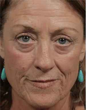 Before - Patricia W
