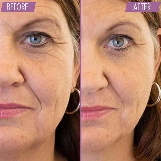 Athena 7 Minute Lift Before and After 2