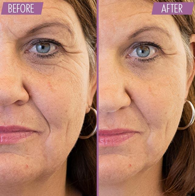 Before and after Crows Feet - Athena 7 Minute Lift by Adonia Organics